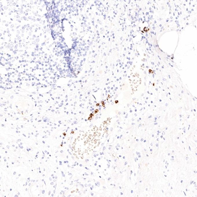 IHC staining of human appendicitis using 81610-1-RR Immunohistochemistry (IHC) staining of human appendicitis tissue using MPO Recombinant monoclonal antibody (81610-1-RR)