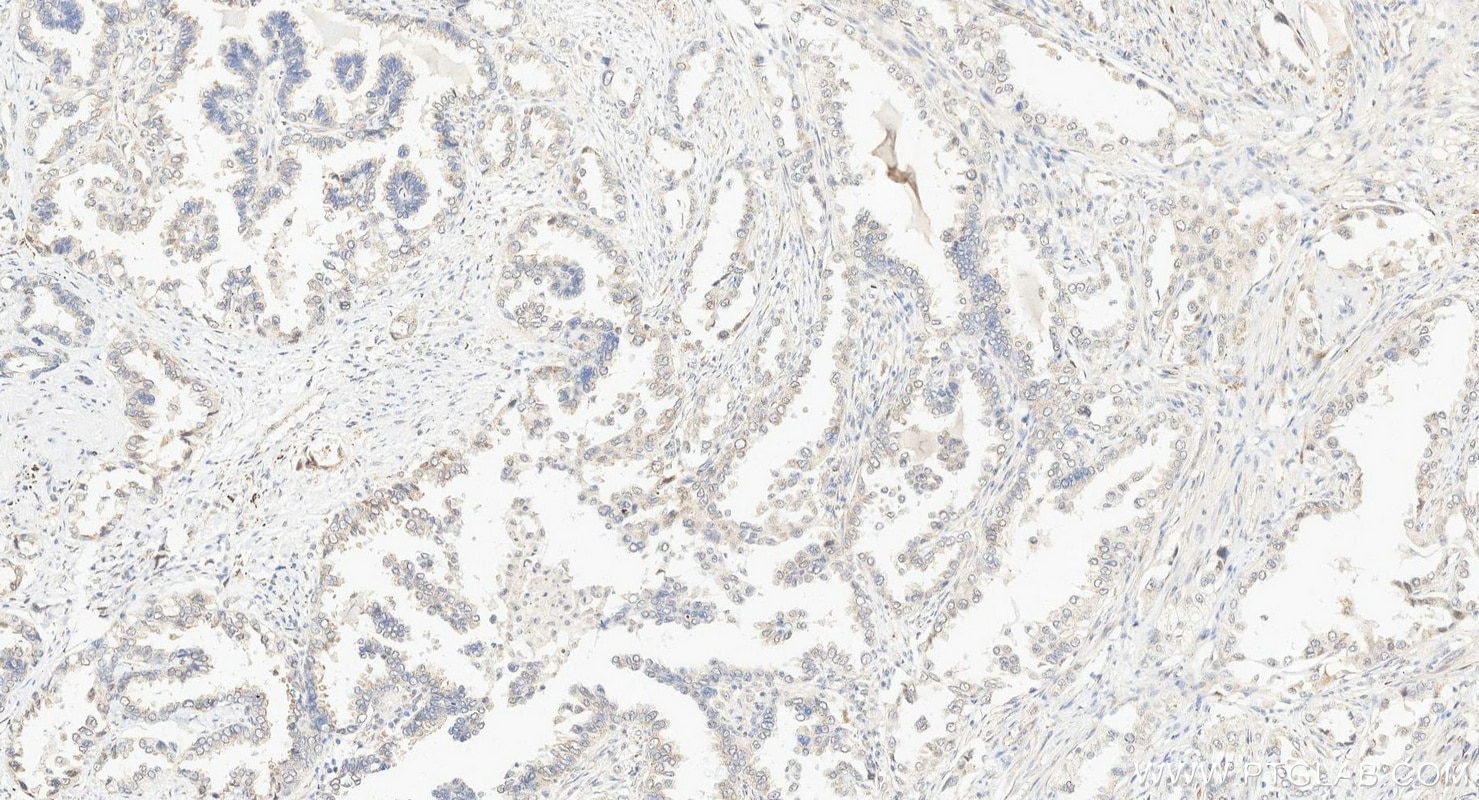 Immunohistochemistry (IHC) staining of human lung cancer tissue using MPP3 Polyclonal antibody (14650-1-AP)