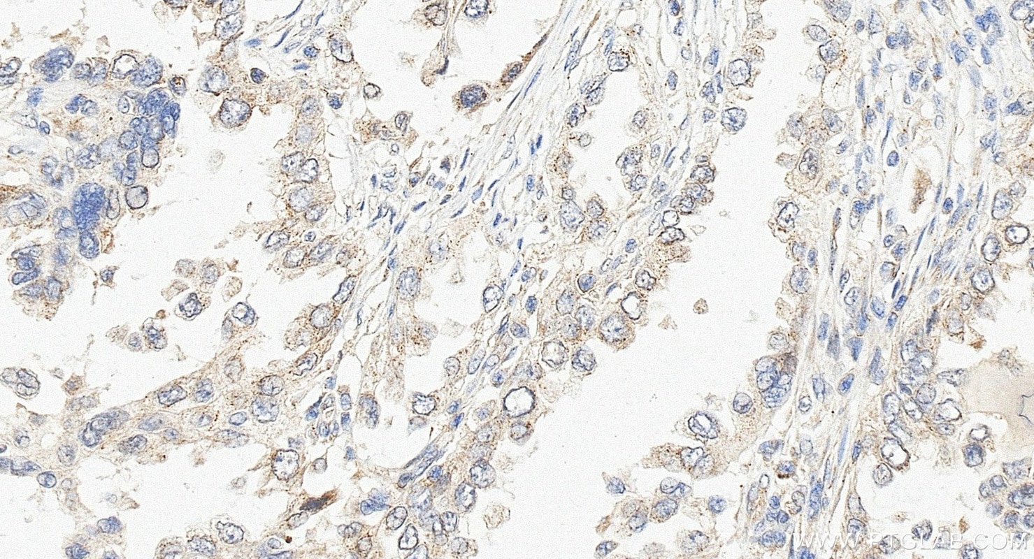 Immunohistochemistry (IHC) staining of human lung cancer tissue using MPP3 Polyclonal antibody (14650-1-AP)