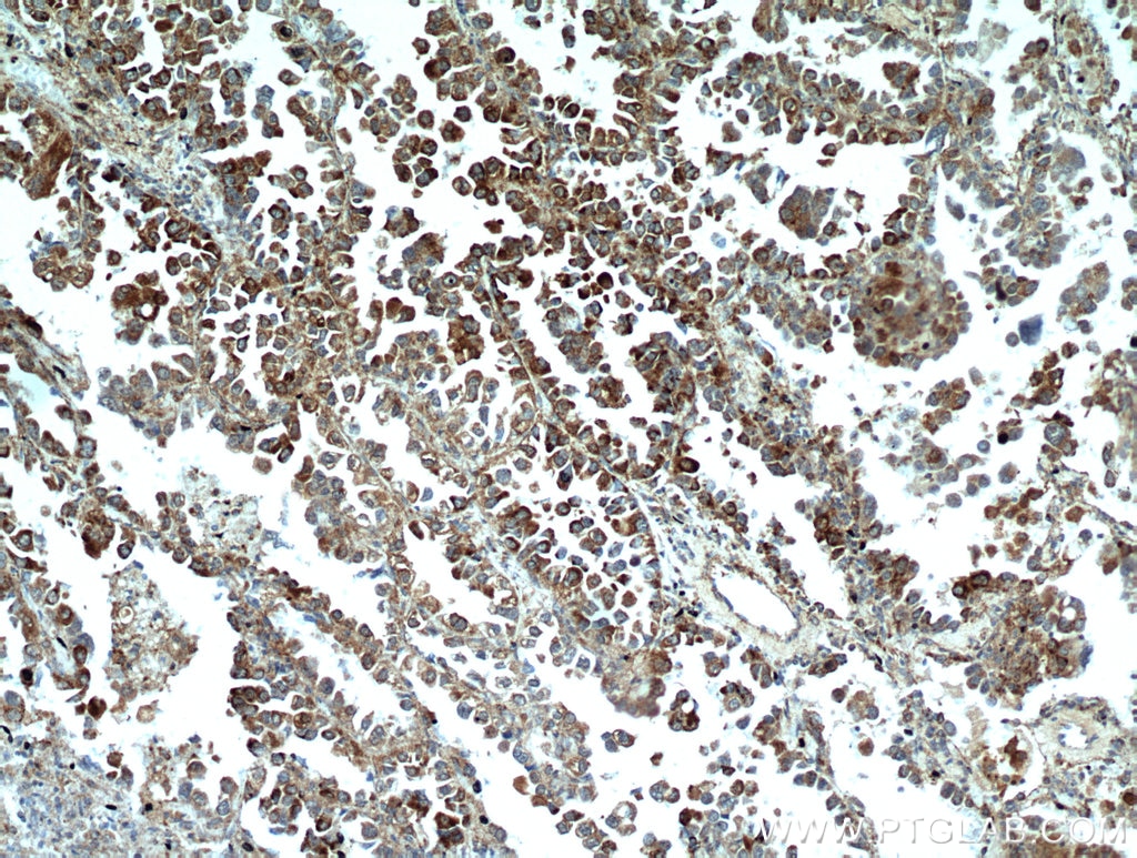 IHC staining of human lung cancer using 14650-1-AP