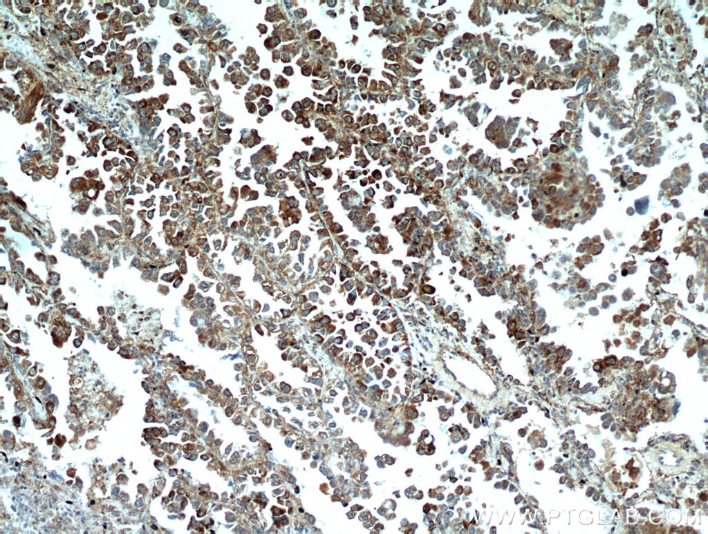 Immunohistochemistry (IHC) staining of human lung cancer tissue using MPP3 Polyclonal antibody (14650-1-AP)