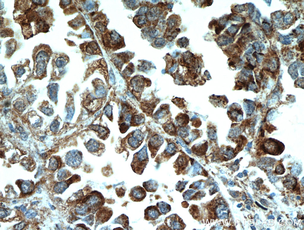 Immunohistochemistry (IHC) staining of human lung cancer tissue using MPP3 Polyclonal antibody (14650-1-AP)