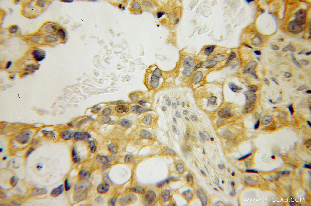 Immunohistochemistry (IHC) staining of human ovary tumor tissue using MPP7 Polyclonal antibody (12983-1-AP)