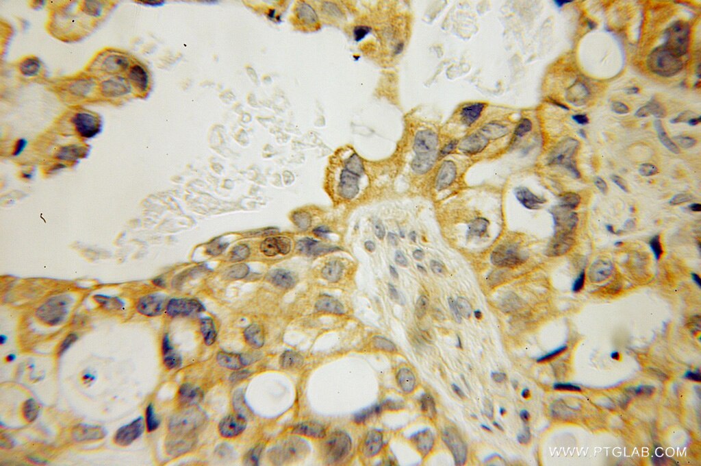 IHC staining of human ovary tumor using 12983-1-AP