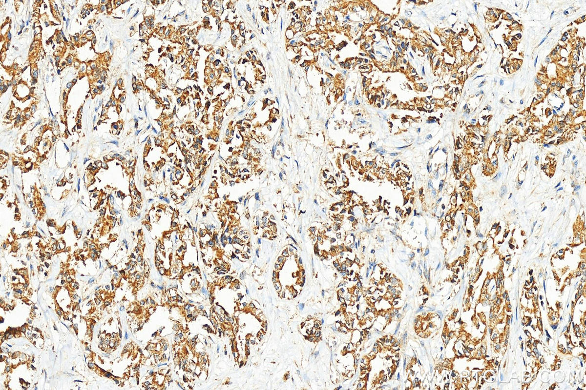 Immunohistochemistry (IHC) staining of human intrahepatic cholangiocarcinoma tissue using MPV17 Polyclonal antibody (10310-1-AP)