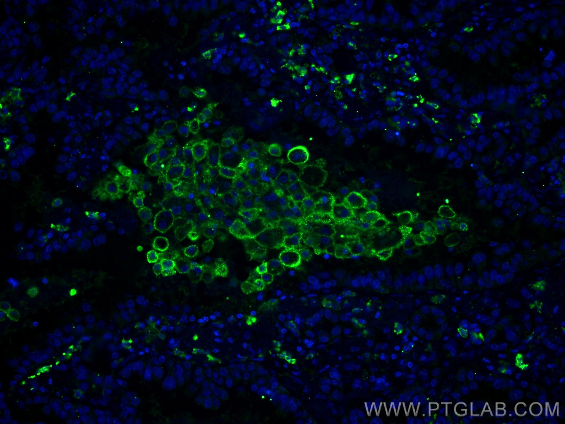 Immunofluorescence (IF) / fluorescent staining of human lung cancer tissue using CD206 Monoclonal antibody (60143-1-Ig)