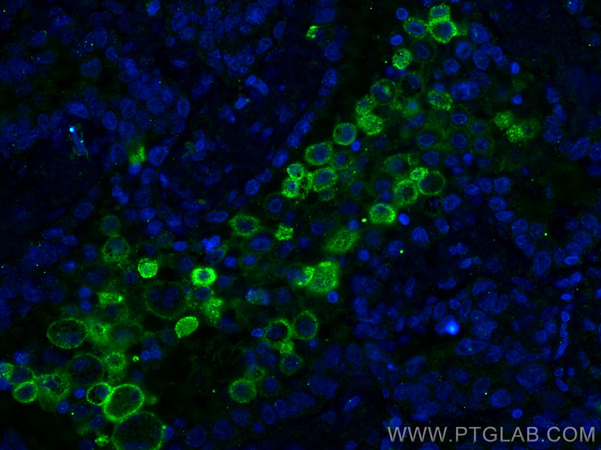 Immunofluorescence (IF) / fluorescent staining of human lung cancer tissue using CD206 Monoclonal antibody (60143-1-Ig)