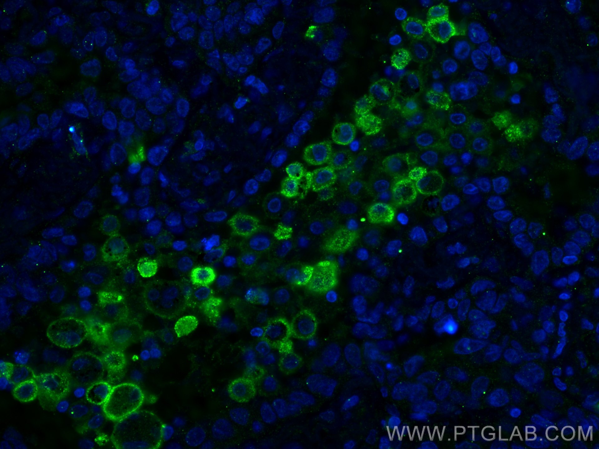 IF Staining of human lung cancer using 60143-1-Ig