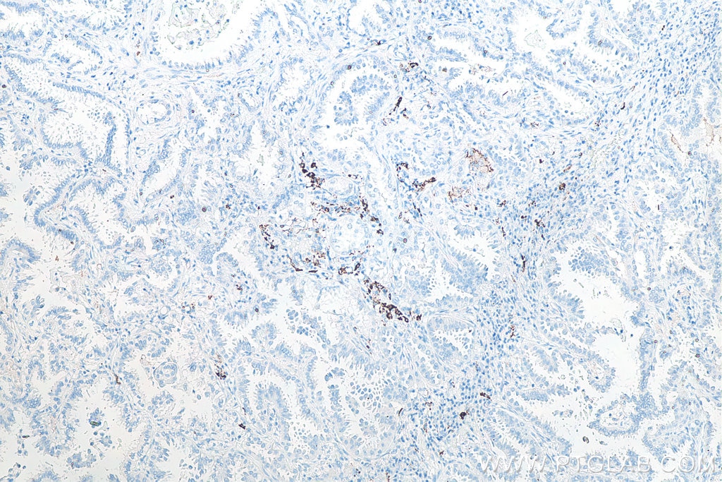 Immunohistochemistry (IHC) staining of human lung cancer tissue using CD206 Monoclonal antibody (60143-1-Ig)