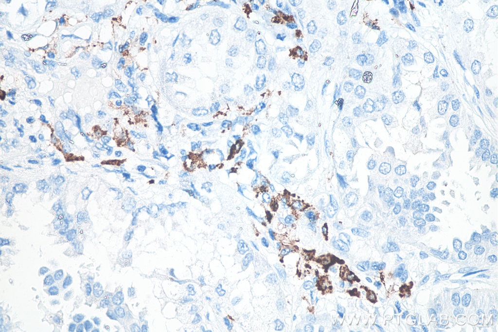 Immunohistochemistry (IHC) staining of human lung cancer tissue using CD206 Monoclonal antibody (60143-1-Ig)