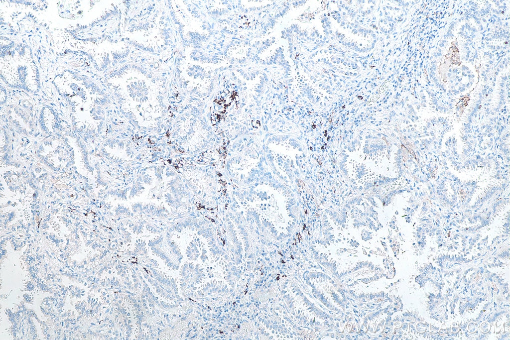 IHC staining of human lung cancer using 60143-1-Ig Immunohistochemistry (IHC) staining of human lung cancer tissue using CD206 Monoclonal antibody (60143-1-Ig)