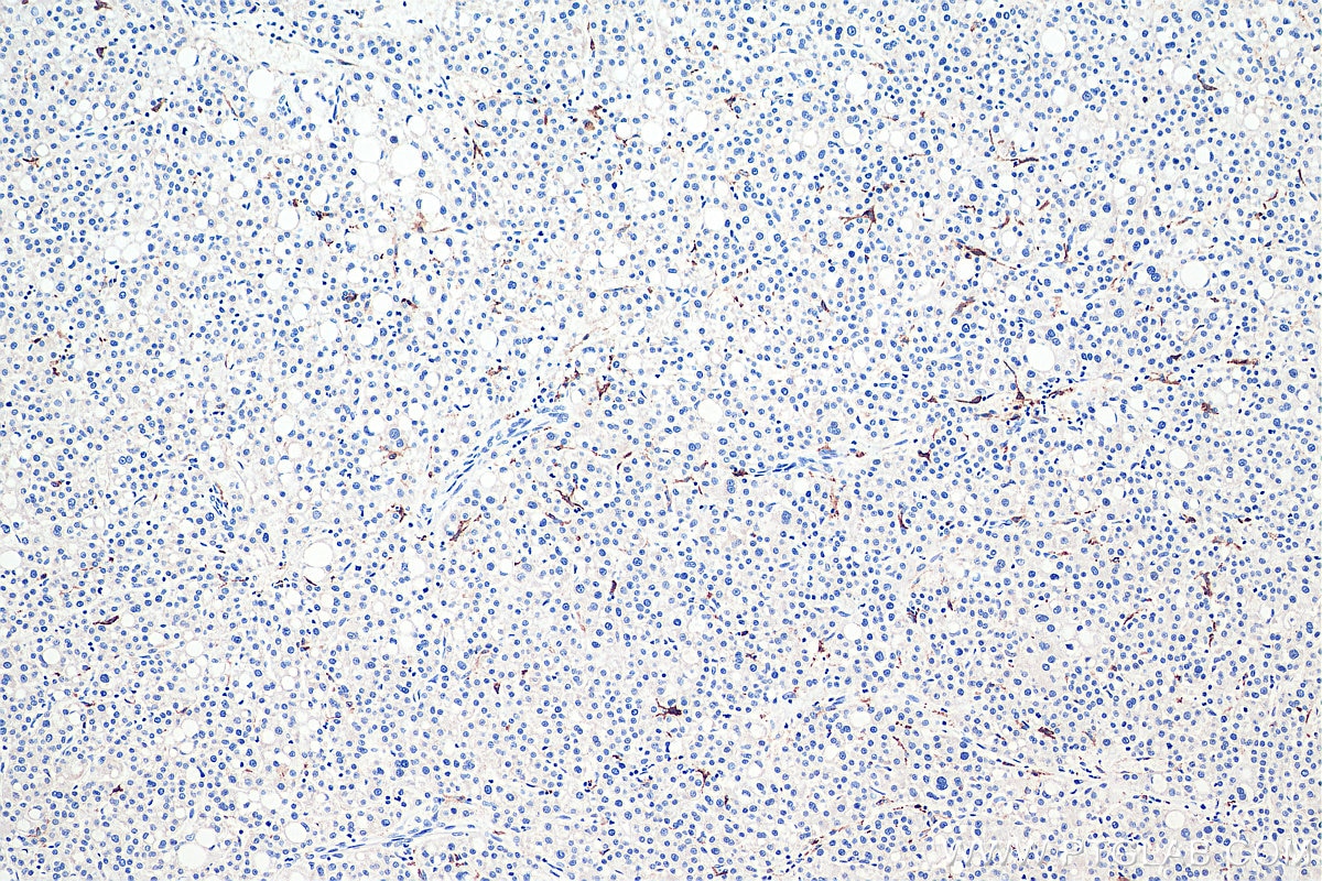 IHC staining of human liver cancer using 60143-1-Ig Immunohistochemistry (IHC) staining of human liver cancer tissue using CD206 Monoclonal antibody (60143-1-Ig)