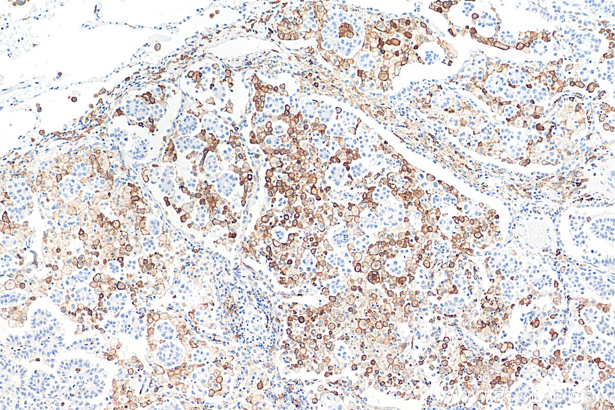 Immunohistochemistry (IHC) staining of human lung cancer tissue using CD206 Recombinant antibody (81525-1-RR)