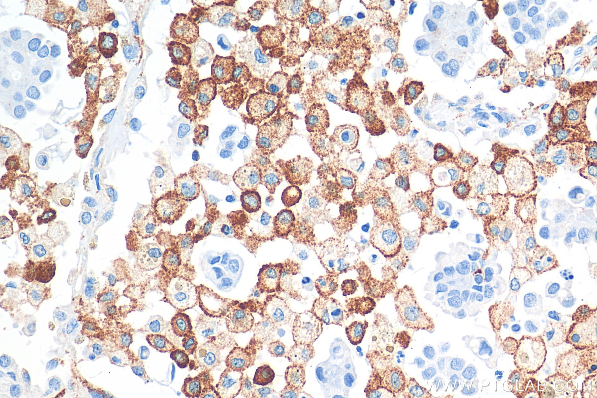 IHC staining of human lung cancer using 81525-1-RR