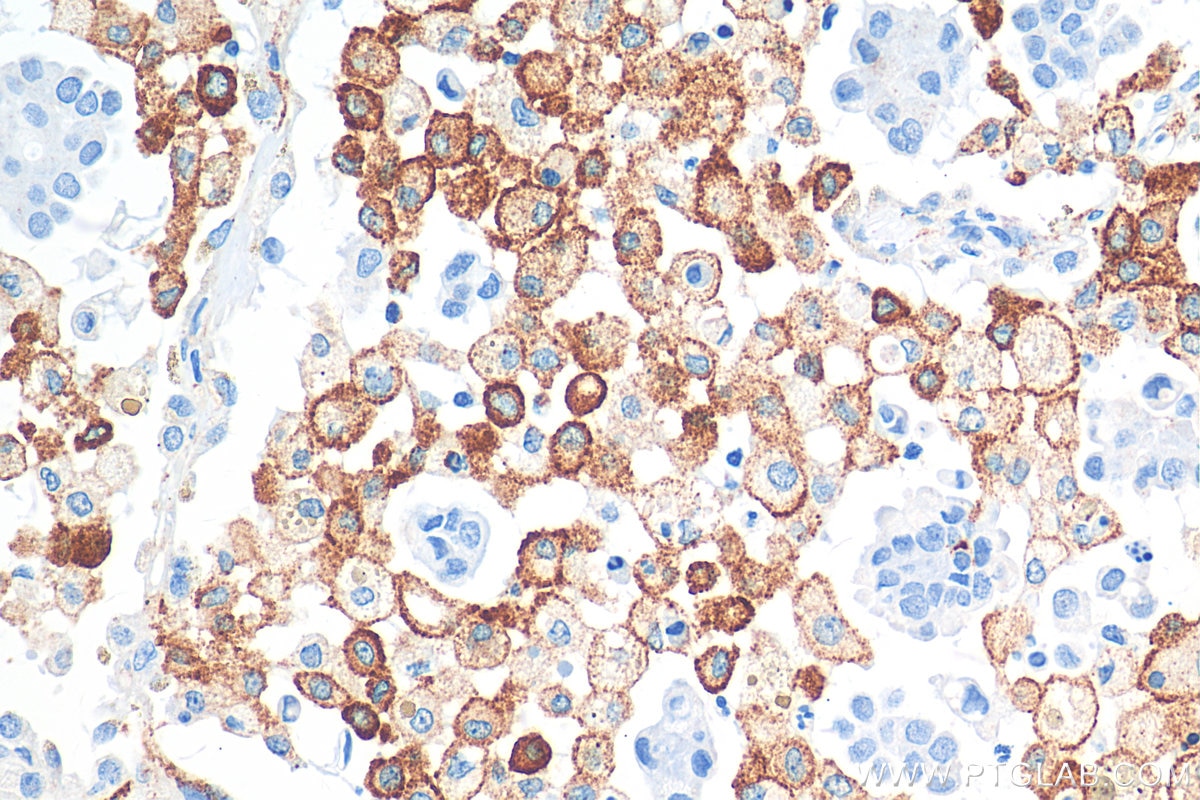 Immunohistochemistry (IHC) staining of human lung cancer tissue using CD206 Recombinant antibody (81525-1-RR)