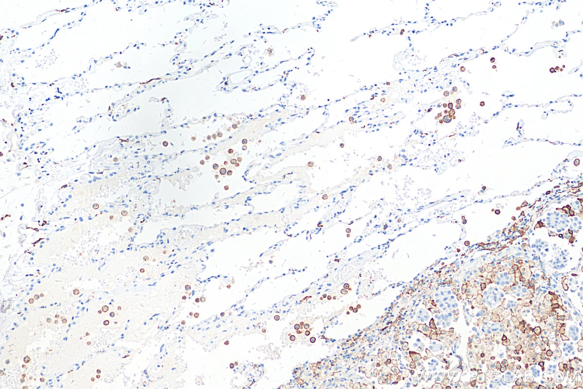 Immunohistochemistry (IHC) staining of human lung cancer tissue using CD206 Recombinant antibody (81525-1-RR)