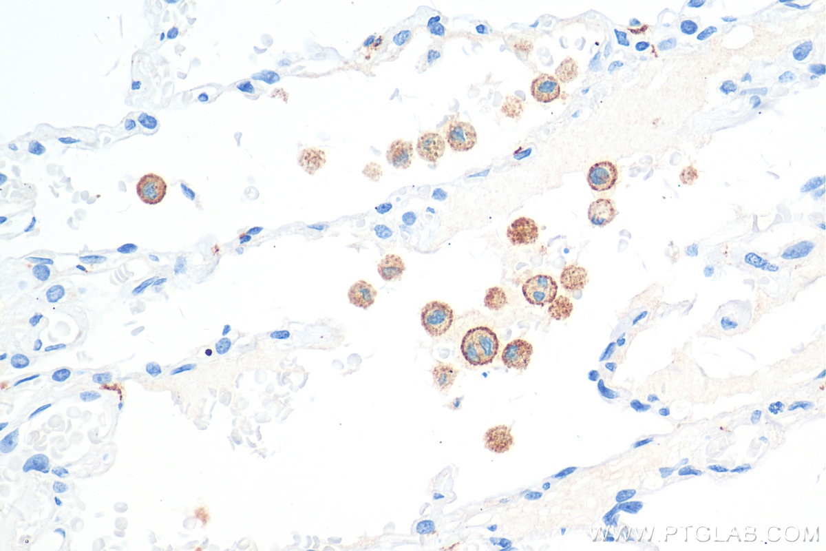 Immunohistochemistry (IHC) staining of human lung cancer tissue using CD206 Recombinant antibody (81525-1-RR)