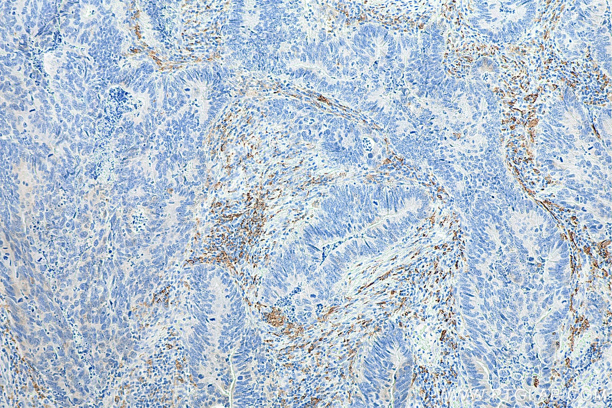 IHC staining of human colon cancer using 81525-1-RR