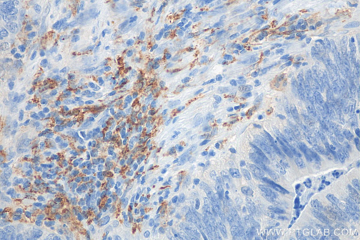 Immunohistochemistry (IHC) staining of human colon cancer tissue using CD206 Recombinant antibody (81525-1-RR)