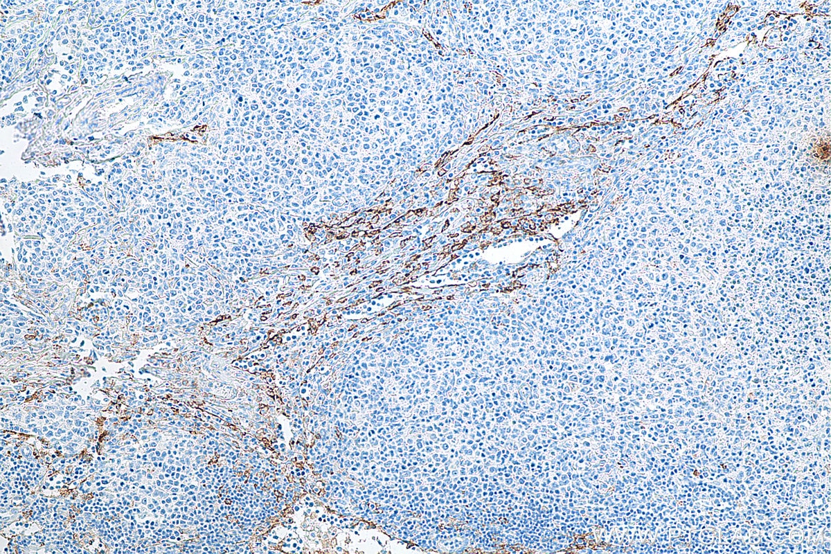 IHC staining of human lymphoma using 81525-1-RR