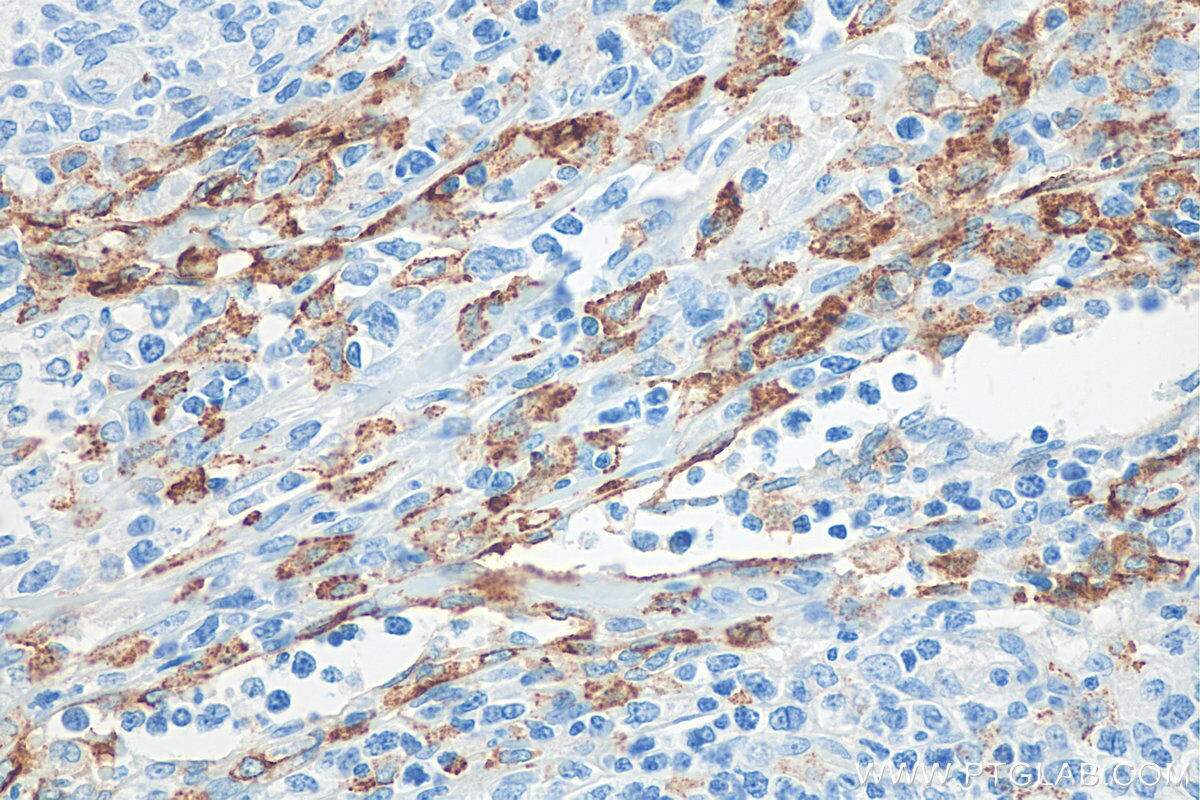 Immunohistochemistry (IHC) staining of human lymphoma tissue using CD206 Recombinant antibody (81525-1-RR)