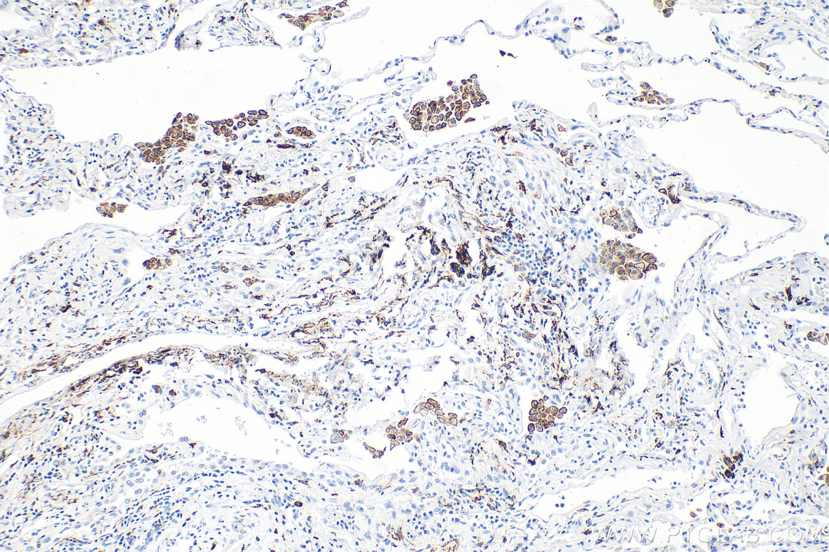 Immunohistochemistry (IHC) staining of human lung tissue using CD206 Recombinant monoclonal antibody (81525-1-RR)