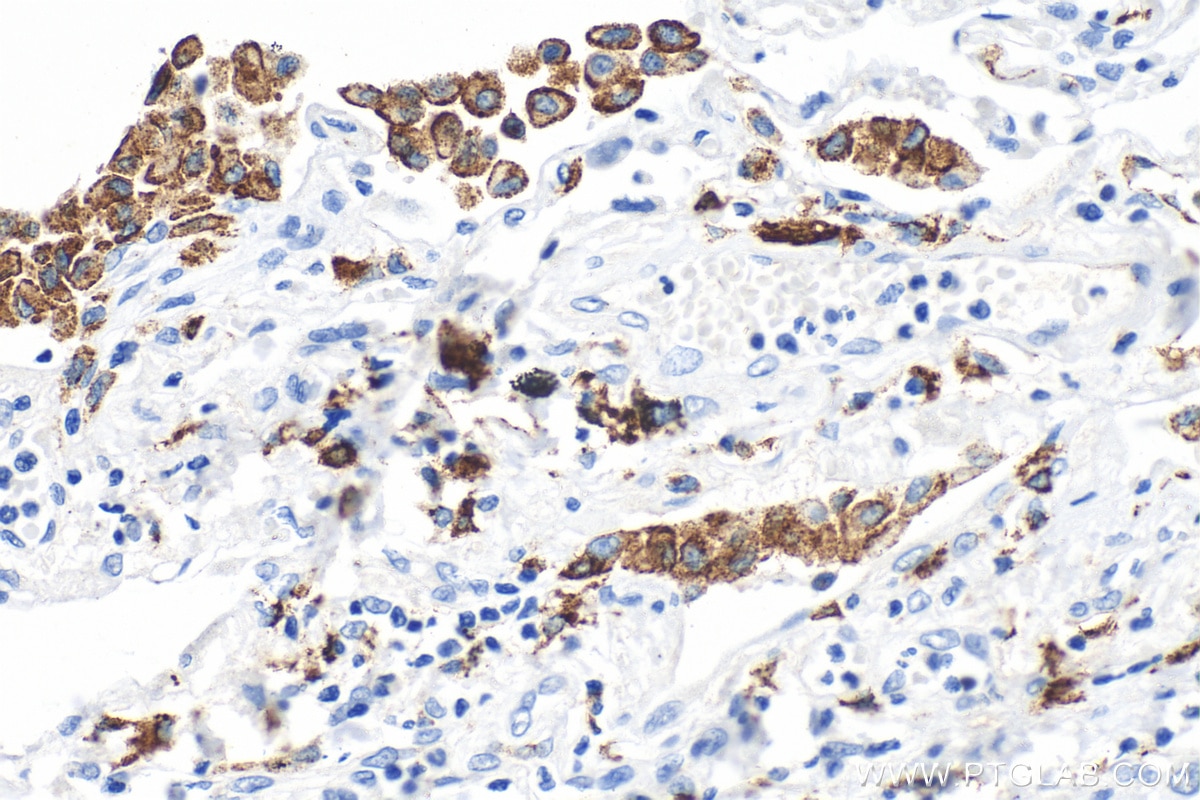 Immunohistochemistry (IHC) staining of human lung tissue using CD206 Recombinant monoclonal antibody (81525-1-RR)