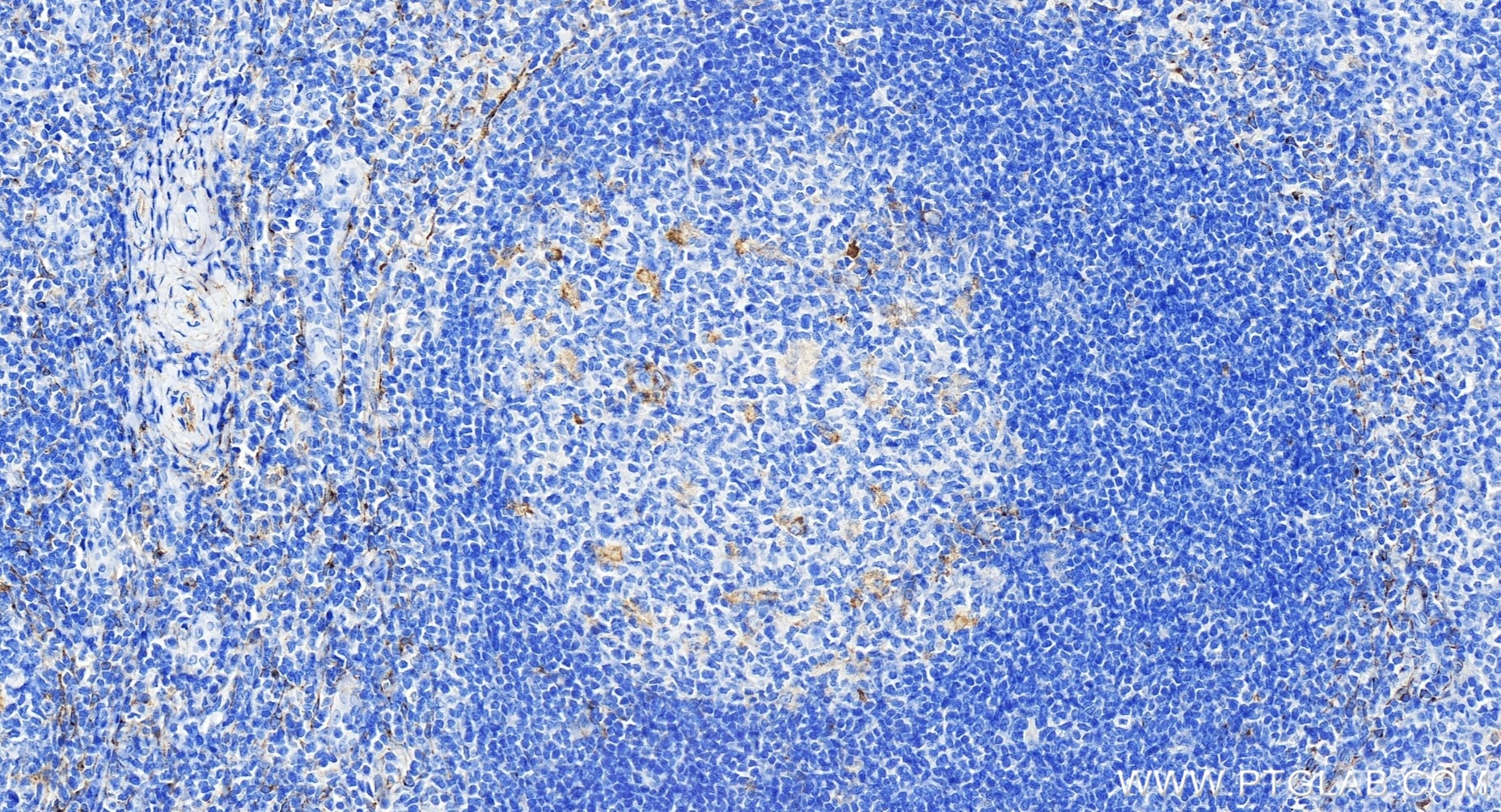 Immunohistochemistry (IHC) staining of human tonsillitis tissue using MRC2 Recombinant antibody (86028-1-RR)