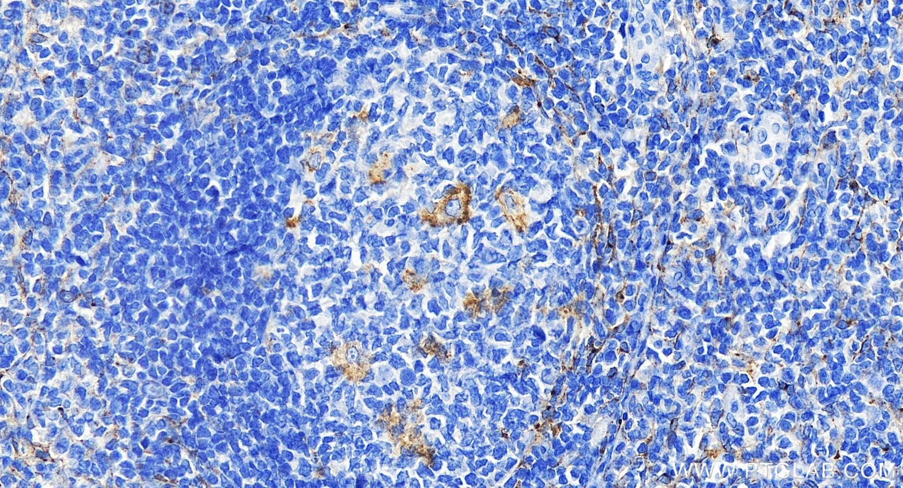 Immunohistochemistry (IHC) staining of human tonsillitis tissue using MRC2 Recombinant antibody (86028-1-RR)