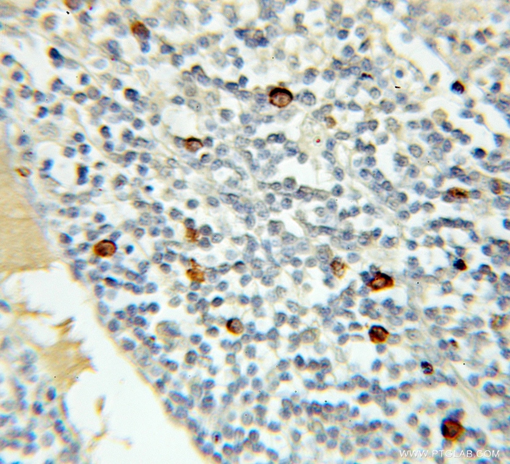 Immunohistochemistry (IHC) staining of human lymphoma tissue using MRE11 Polyclonal antibody (10744-1-AP)
