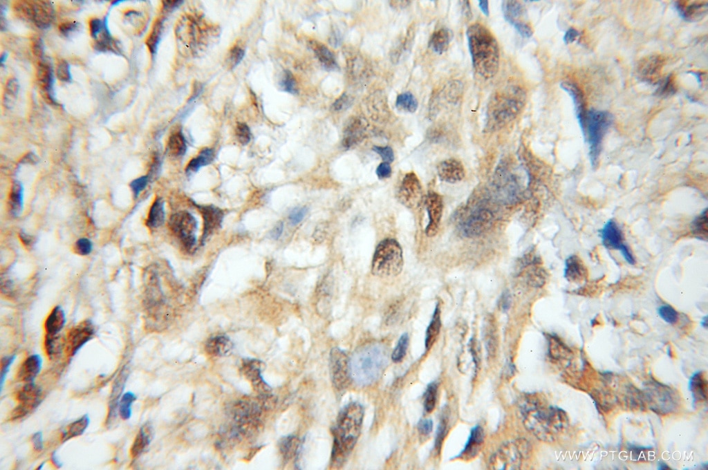 Immunohistochemistry (IHC) staining of human gliomas tissue using MRFAP1 Polyclonal antibody (11639-1-AP)