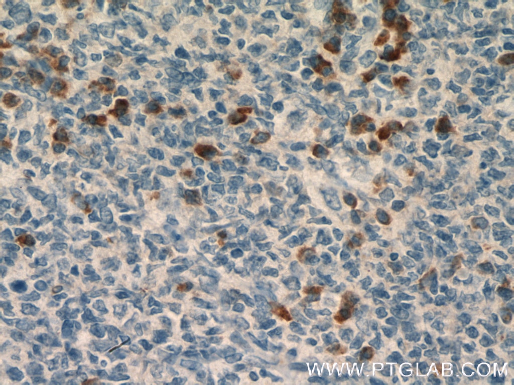 Immunohistochemistry (IHC) staining of human tonsillitis tissue using MRGPRX2 Polyclonal antibody (22375-1-AP)