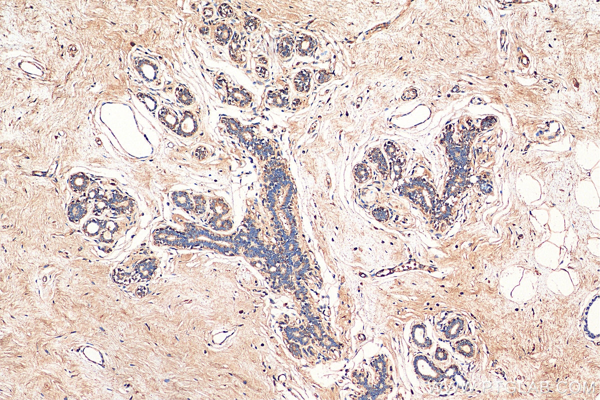 Immunohistochemistry (IHC) staining of human breast cancer tissue using MRP1 Polyclonal antibody (27825-1-AP)