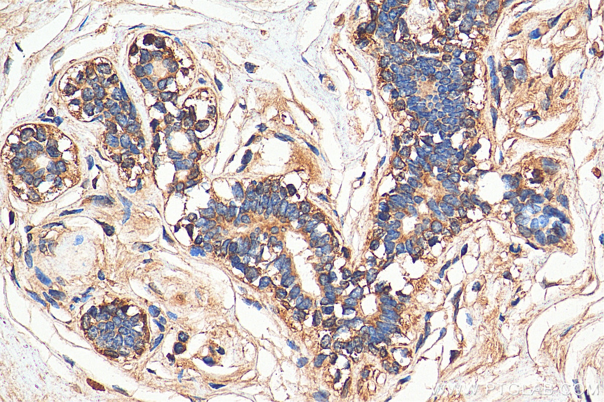 Immunohistochemistry (IHC) staining of human breast cancer tissue using MRP1 Polyclonal antibody (27825-1-AP)