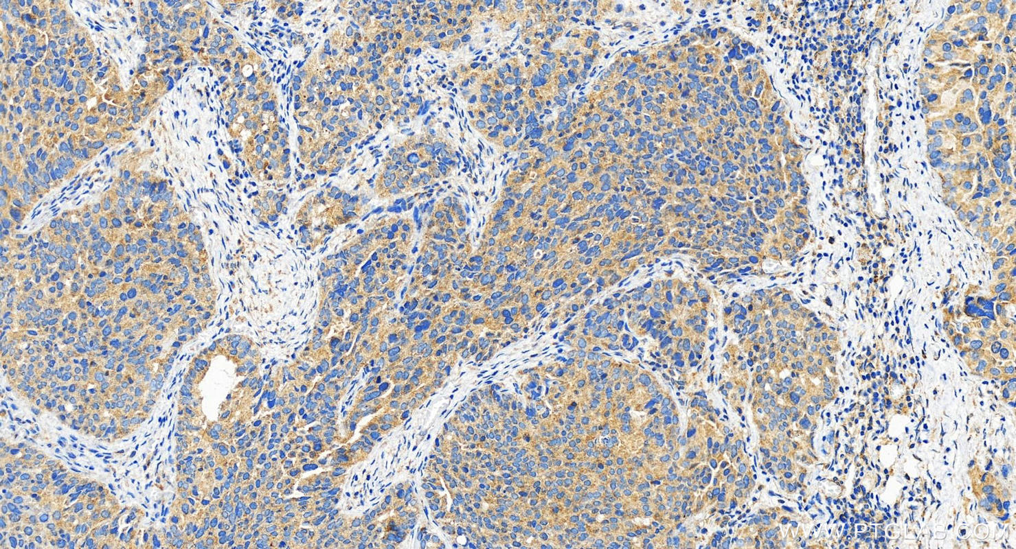 Immunohistochemistry (IHC) staining of human ovary cancer tissue using ABCC5 Polyclonal antibody (29792-1-AP)