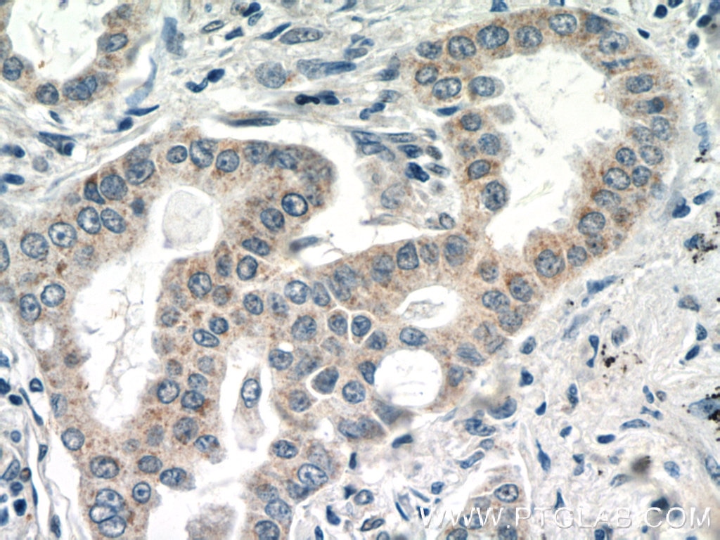 Immunohistochemistry (IHC) staining of human lung cancer tissue using MRPL1 Polyclonal antibody (16254-1-AP)