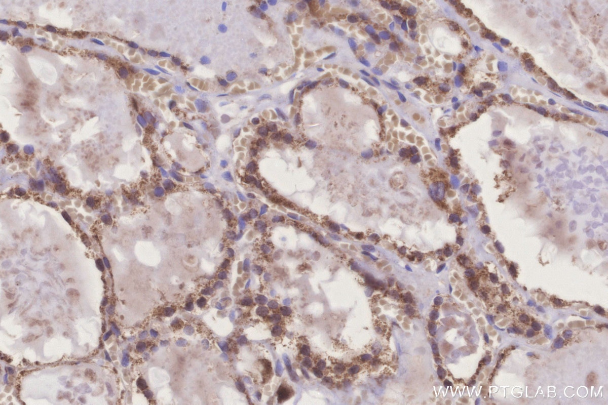 Immunohistochemistry (IHC) staining of human thyroid cancer tissue using MRPL10 Polyclonal antibody (16652-1-AP)