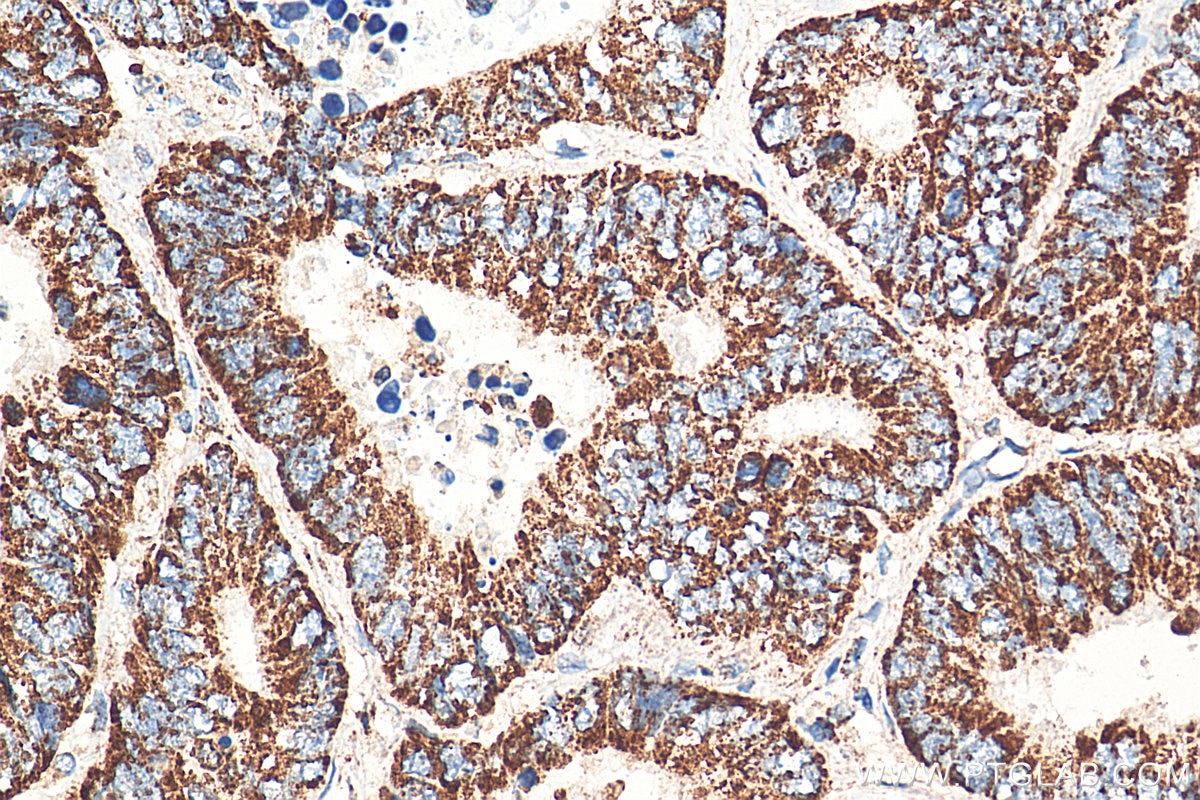 Immunohistochemistry (IHC) staining of human colon cancer tissue using MRPL12 Polyclonal antibody (14795-1-AP)