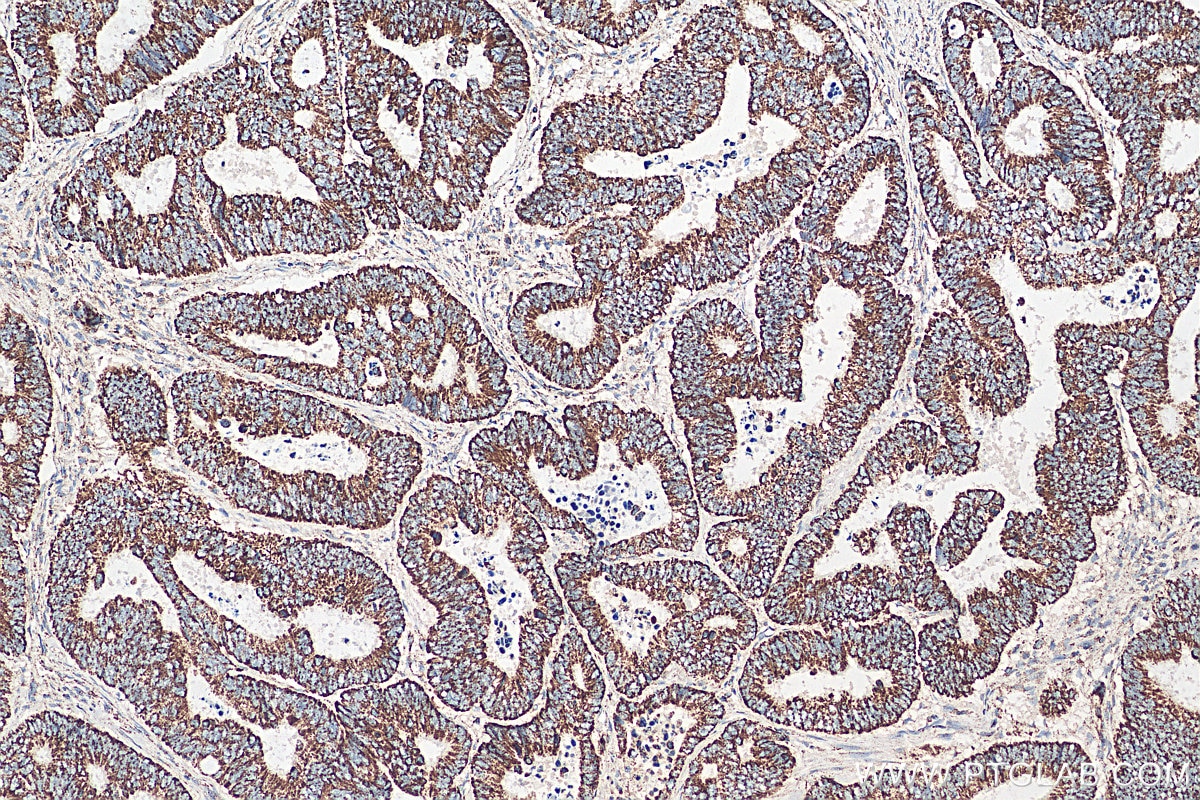 Immunohistochemistry (IHC) staining of human colon cancer tissue using MRPL12 Polyclonal antibody (14795-1-AP)