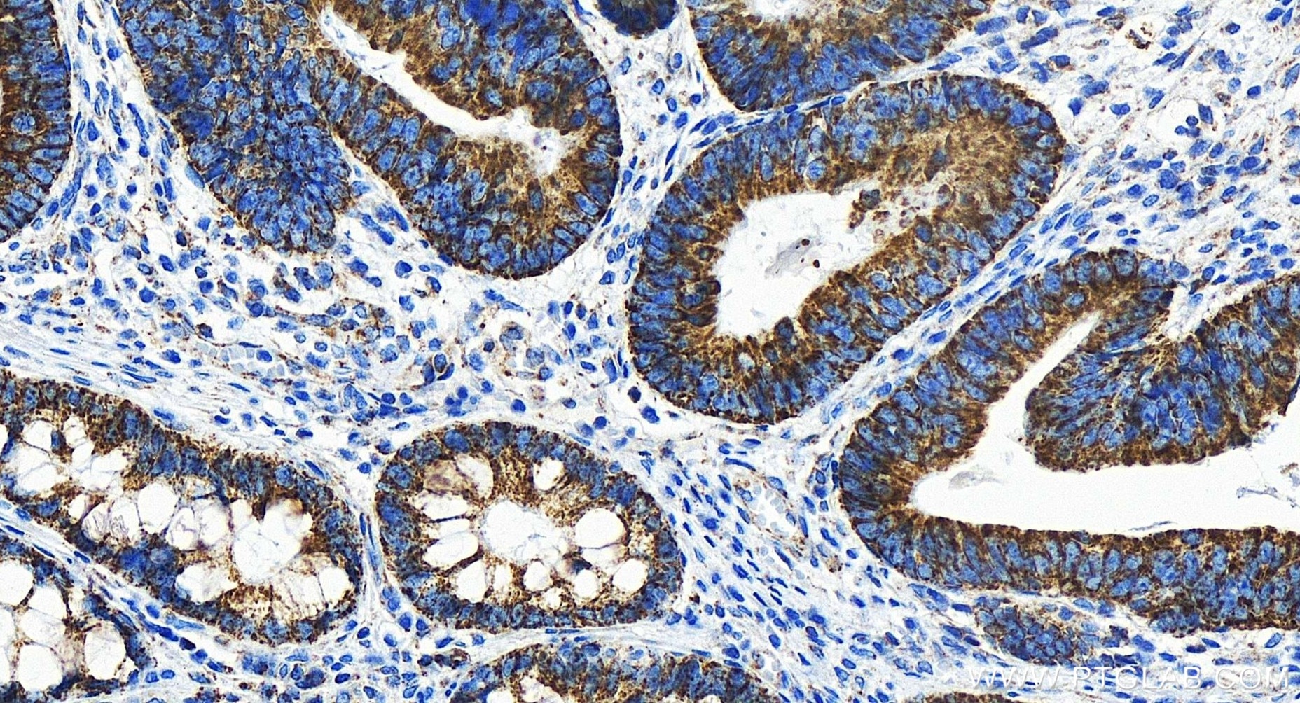 Immunohistochemistry (IHC) staining of human colon cancer tissue using MRPL12 Recombinant antibody (85070-5-RR)