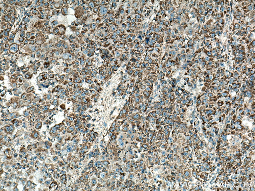 Immunohistochemistry (IHC) staining of human liver cancer tissue using MRPL13 Polyclonal antibody (16241-1-AP)