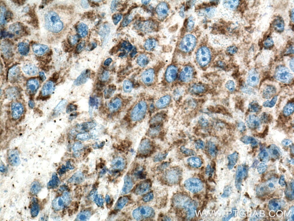 Immunohistochemistry (IHC) staining of human liver cancer tissue using MRPL13 Polyclonal antibody (16241-1-AP)