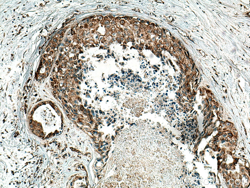 Immunohistochemistry (IHC) staining of human breast cancer tissue using MRPL13 Polyclonal antibody (16241-1-AP)