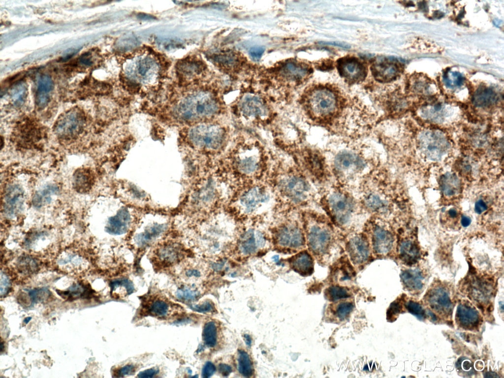 Immunohistochemistry (IHC) staining of human breast cancer tissue using MRPL13 Polyclonal antibody (16241-1-AP)