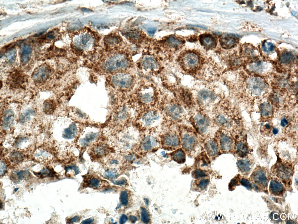 Immunohistochemistry (IHC) staining of human breast cancer tissue using MRPL13 Polyclonal antibody (16241-1-AP)