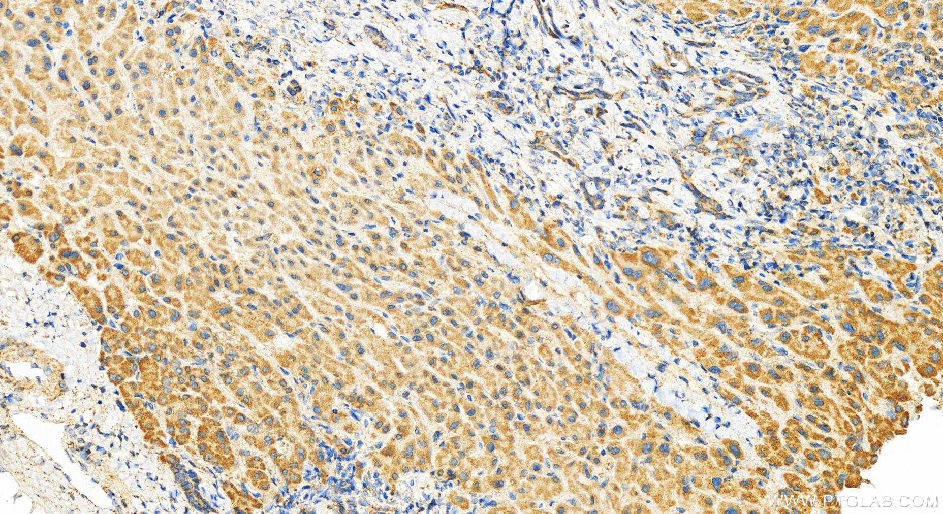 Immunohistochemistry (IHC) staining of human intrahepatic cholangiocarcinoma tissue using MRPL16 Polyclonal antibody (14762-1-AP)