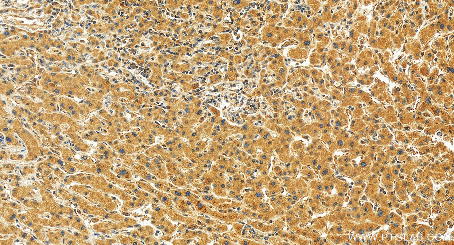 Immunohistochemistry (IHC) staining of human intrahepatic cholangiocarcinoma tissue using MRPL22 Polyclonal antibody (16299-1-AP)