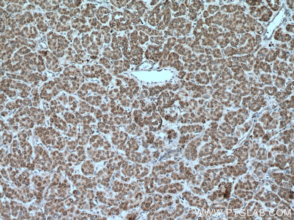 Immunohistochemistry (IHC) staining of human liver cancer tissue using MRPL23 Polyclonal antibody (11706-1-AP)