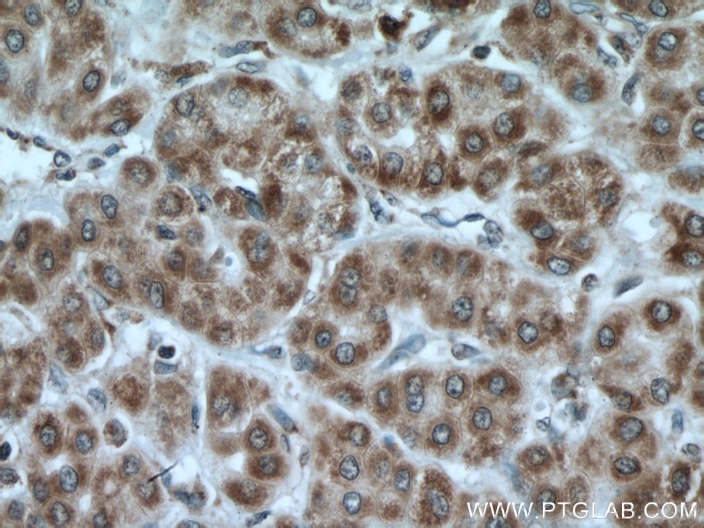 Immunohistochemistry (IHC) staining of human liver cancer tissue using MRPL23 Polyclonal antibody (11706-1-AP)