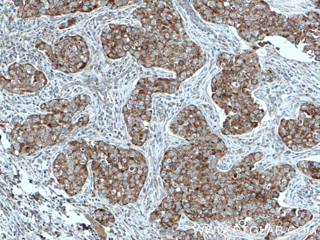 Immunohistochemistry (IHC) staining of human breast cancer tissue using MRPL23 Monoclonal antibody (66595-1-Ig)